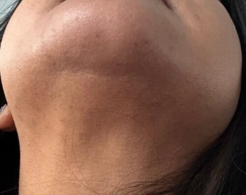 Click to view full screen IceZen Air+ Painless IPL Hair Removal Device photo review