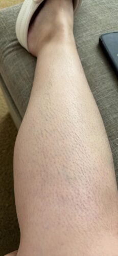 Click to view full screen IceZen Air+ Painless IPL Hair Removal Device photo review