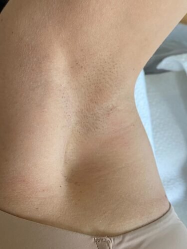 Click to view full screen IceZen Air+ Painless IPL Hair Removal Device photo review